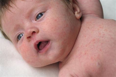 Alergia en el bebé y el niño - causas